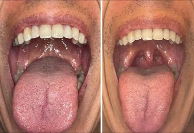 Before and after tongue tie release &mdash; improved tongue mobility and posture
