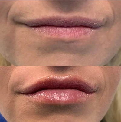Before and after lip enhancement &mdash; smoother, fuller appearance