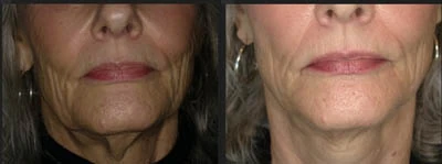 Before and after neck rejuvenation — reduced wrinkles and tighter skin